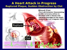 A Heart Attack in Progress