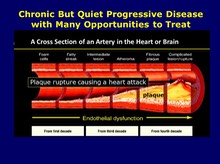 Atherosclerosis is a Naturally Progressive Disease 