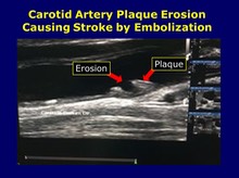Carotid Plaque Erosion, Embolization and Stroke