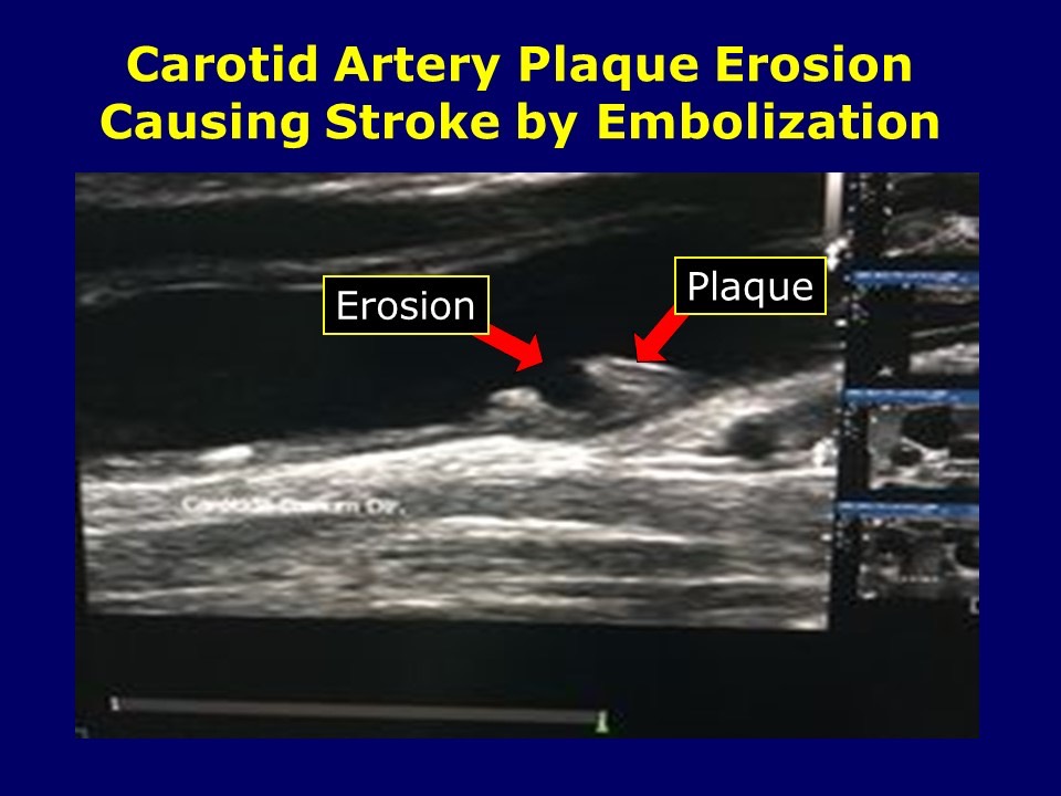 Carotid Plaque Erosion, Embolization and Stroke