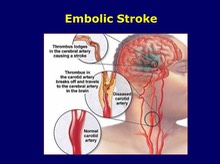 Embolic Stroke