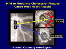 Mild to Moderate Plaques Cause Most Heart Attacks and Strokes