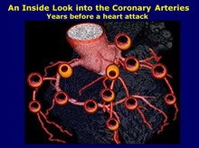 Multiple Coronary Plaques